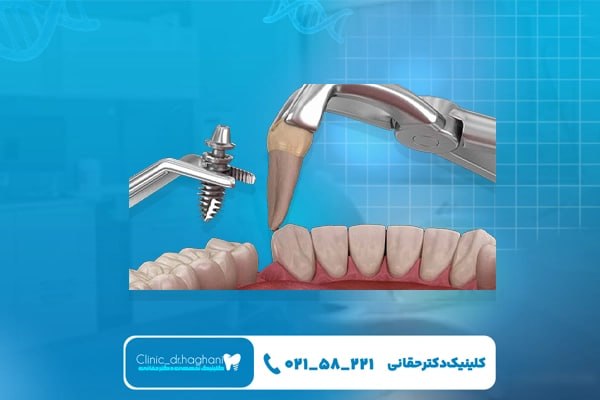 رازهای افزایش طول عمر ایمپلنت دندان