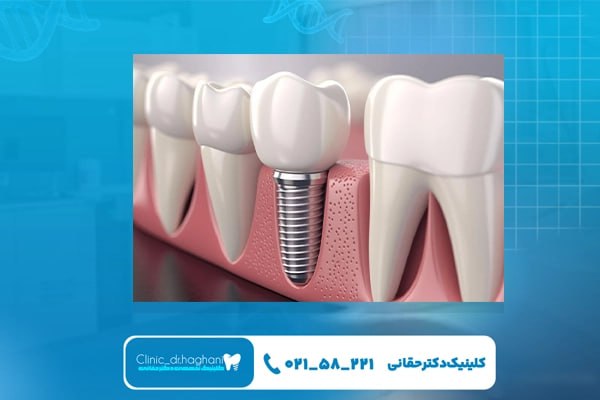 جراح ایمپلنت دندان جراح ایمپلنت دندان