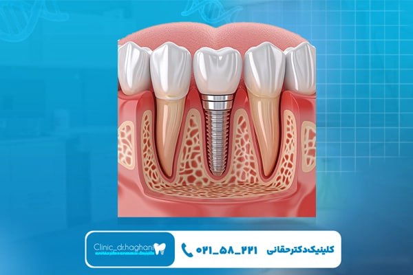 مراحل انجام جراحی ایمپلنت دندان شامل چیست؟ مراحل انجام جراحی ایمپلنت دندان شامل چیست؟