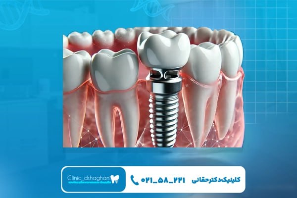 مزیتهای کاشت ایمپلنت توسط جراح متخصص مزیتهای کاشت ایمپلنت توسط جراح متخصص
