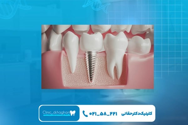 کلینیک تخصصی ایمپلنت تهران