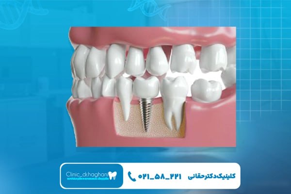 مراحل جراحی ایمپلنت دندان