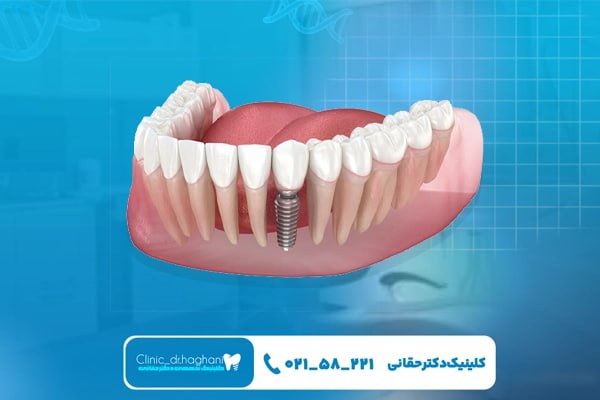 کلینیک تخصصی ایمپلنت
