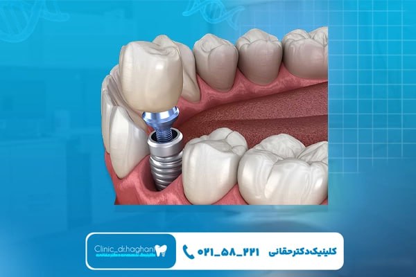ایمپلنت دیجیتال تهران