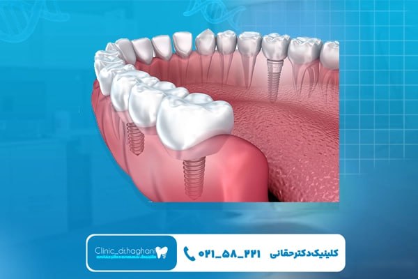 نکات مراقبتی قبل از انجام ایمپلنت دیجیتال
