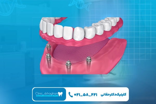کاشت ایمپلنت دیجیتال برای دندان‌های جلو 
