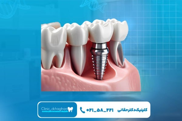 ایمپلنت کرهای تهران ایمپلنت کرهای تهران