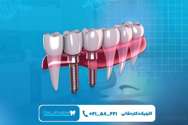ایمپلنت دندان کرهای در کلینیک دندانپزشکی دکتر حقانی ایمپلنت دندان کرهای در کلینیک دندانپزشکی دکتر حقانی