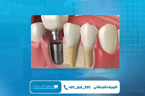 برند های ایمپلنت دندان کرهای برند های ایمپلنت دندان کرهای