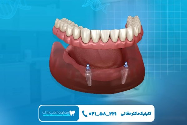 ایمپلنت فک کامل تهران