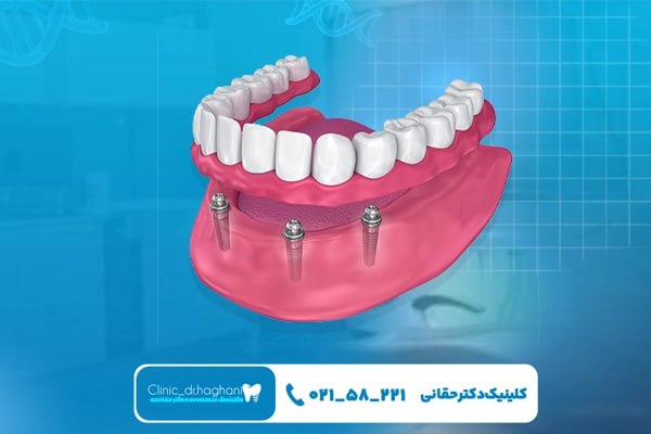 مزایای ایمپلنت فک کامل تهران