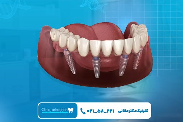 قیمت ایمپلنت فک کامل تهران