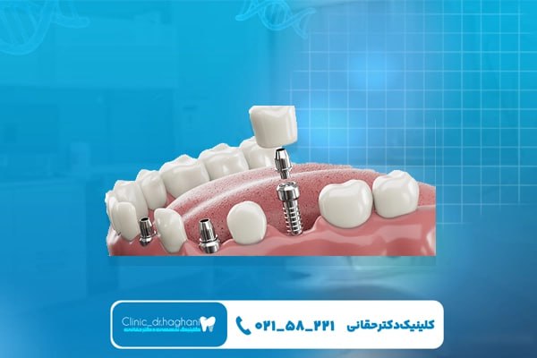  کلینیک دندانپزشکی دکتر حقانی بهترین گزینه برای ایمپلنت