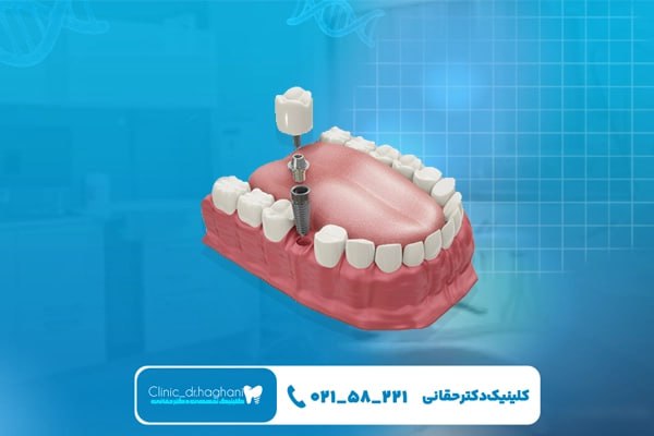 مراحل انجام ایمپلنت دندان