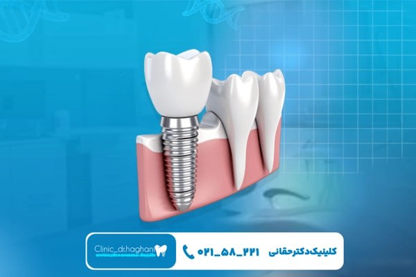 دندانپزشکی تخصصی ایمپلنت در شمال تهران