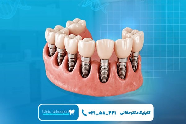 ایمپلنت لوکس تهران