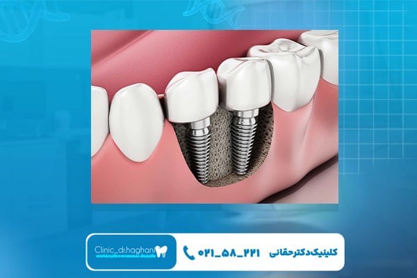 دوام و طول عمر ایمپلنت لوکس چقدر است؟