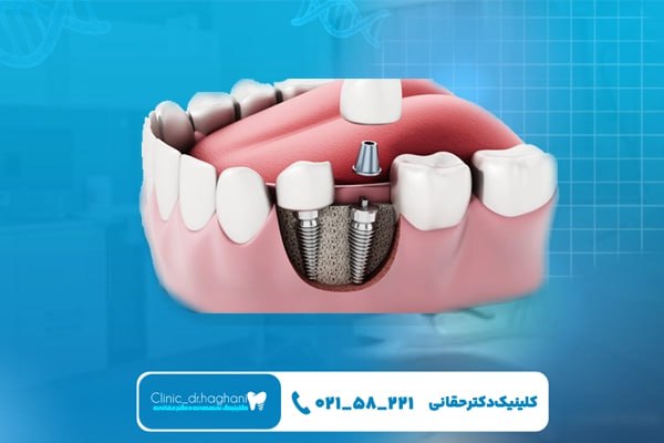 قیمت ایمپلنت لوکس و عوامل مؤثر بر آن