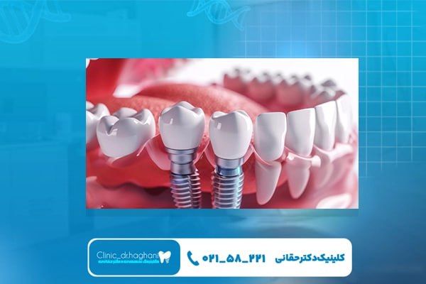 ایمپلنت دندان در شمال تهران