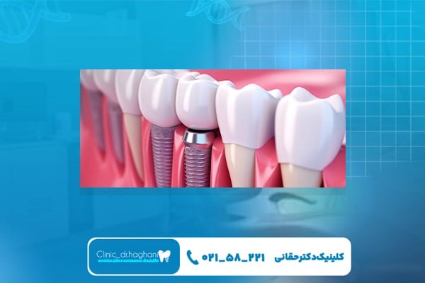  انواع ایمپلنت دندان