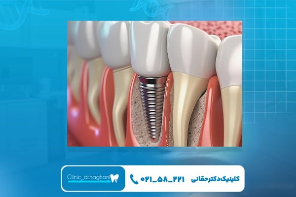 ایمپلنت‌های پیشرفته