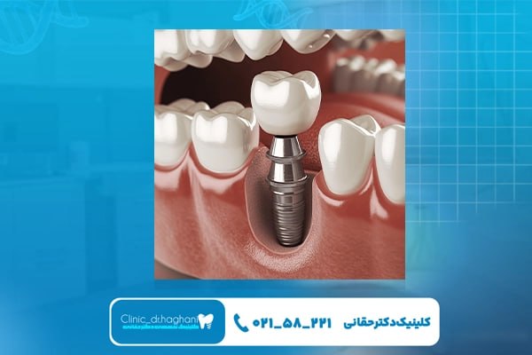 مرکز تخصصی ایمپلنت در تهران