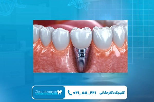 مراحل درمان در مرکز تخصصی ایمپلنت در تهران
