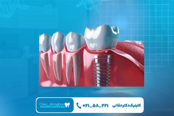 خدمات جامع مرکز تخصصی ایمپلنت در تهران 