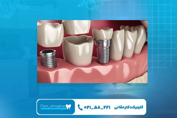 بهترین دندانپزشک ایمپلنت تهران