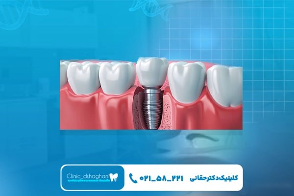 مراحل انجام ایمپلنت دندان