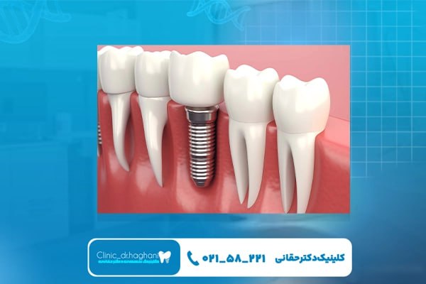 خدمات ایمپلنت دندان با تکنولوژی سه‌بعدی در مرکز دندانپزشکی دکتر حقانی