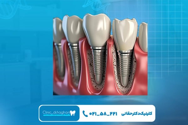 مراحل اجرای ایمپلنت دندان با تکنولوژی سه‌بعدی شامل چیست؟