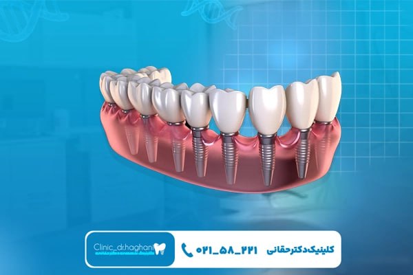 مزیت‌های استفاده از ایمپلنت دندان