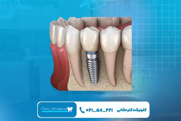 بهترین ایمپلنت دیجیتال در تهران