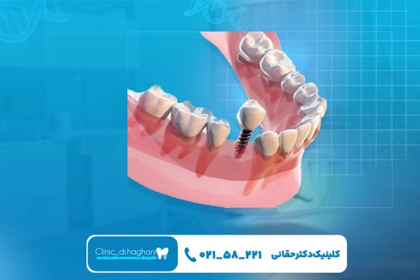 دقت زیاد ایمپلنت‌ دیجیتال