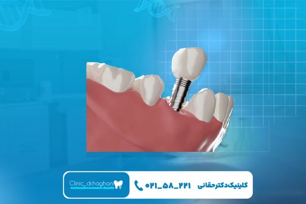 ویژگی بهترین ایمپلنت دیجیتال در تهران