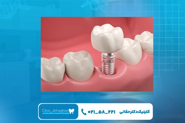 ایمپلنت دندان در مرکز تهران ایمپلنت دندان در مرکز تهران