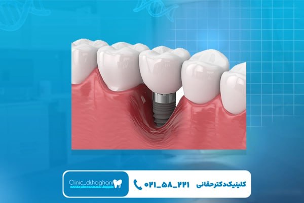 شرایط لازم برای انجام ایمپلنت دندان شامل چیست؟ شرایط لازم برای انجام ایمپلنت دندان شامل چیست؟