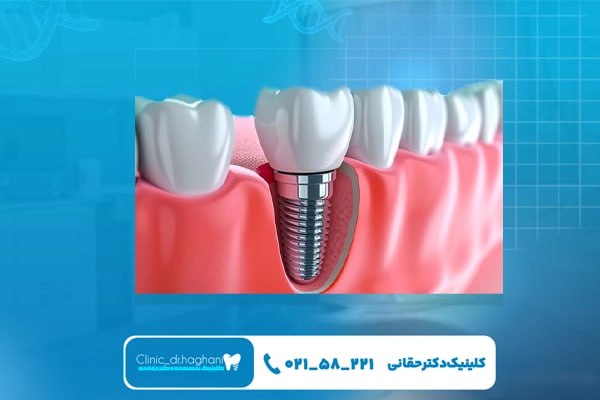خدمات تخصصی ایمپلنت دندان در کلینیک دندانپزشکی دکتر حقانی خدمات تخصصی ایمپلنت دندان در کلینیک دندانپزشکی دکتر حقانی