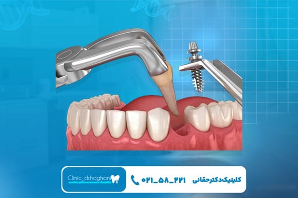 ایمپلنت فوری در کلینیک تخصصی