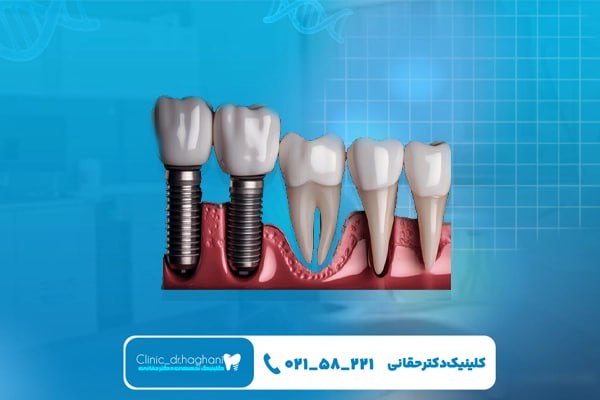 ایمپلنت فوری در کلینیک تخصصی
