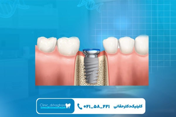 ایمپلنت فوری در کلینیک تخصصی