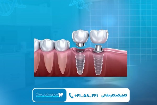 مراحل انجام ایمپلنت دندان