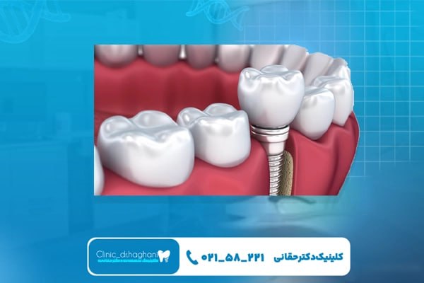 مراحل انجام ایمپلنت دندان