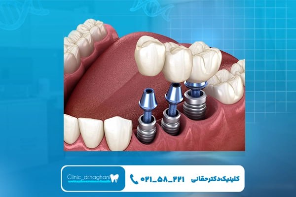 مراحل انجام ایمپلنت دندان