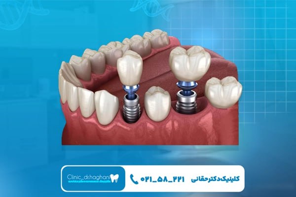 ایمپلنت دندان بهتر است یا بریج