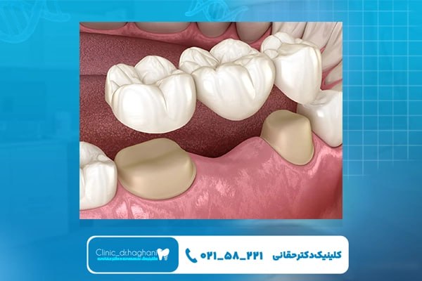 مقایسه ایمپلنت دندان و بریج از نظر شکل ظاهری
