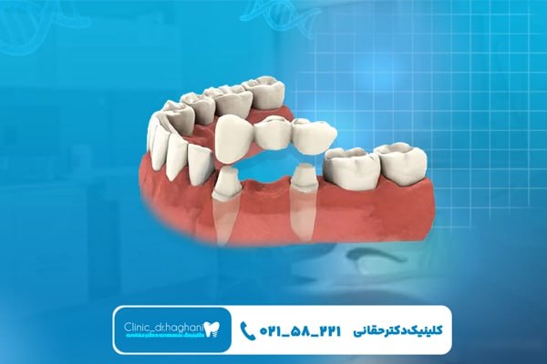  بهترین شیوه جایگزینی دندان بین ایمپلنت و بریج