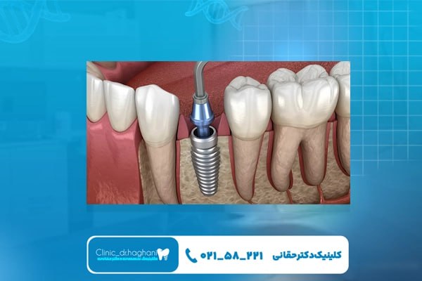 مراقبت‌های تخصصی و مراجعه بعد از کاشت ایمپلنت