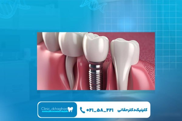 تفاوت ایمپلنت فوری و معمولی